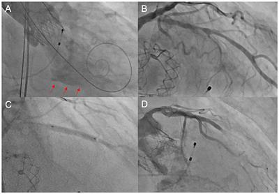 Percutaneous Coronary Intervention in Transcatheter Aortic Valve Implantation Patients: Overview and Practical Management
